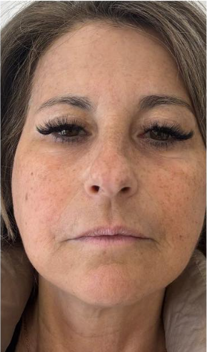 Après traitement HIFU® Visage