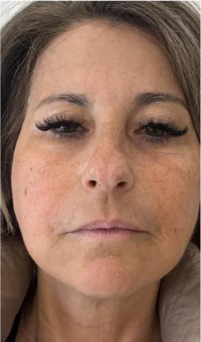 Après traitement HIFU® visage — ovale redessiné et peau raffermie sans chirurgie