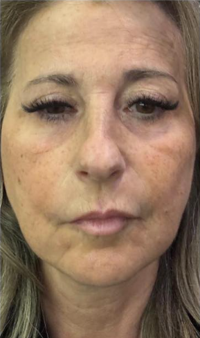 Avant traitement HIFU® Visage